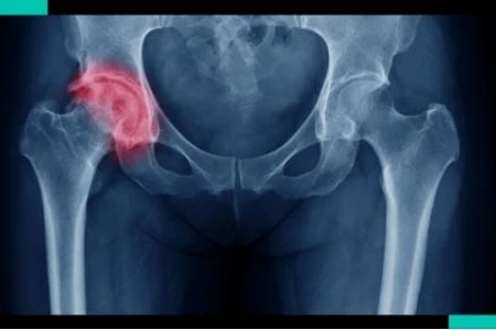 НАЙ-ДОБРОТО ЛЕКАРСТВО ЗА КОКСАРТРОЗА