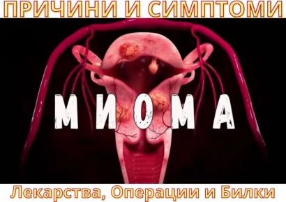 МИОМА НА МАТКАТА | СИМПТОМИ - ЛЕКАРСТВА, ОПЕРАЦИИ И БИЛКИ