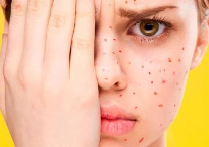 ВАРИЦЕЛА ПРИ ВЪЗРАСТНИ | КАК СЕ ЛЕКУВА | СИМПТОМИ И ДИЕТА