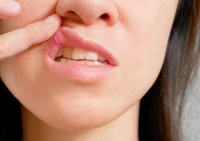 ХЕРПЕС НА УСТАТА | НАЙ-ДОБРОТО ЛЕКАРСТВО | ХАПЧЕТА И БИЛКИ