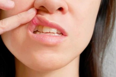 ХЕРЕПЕС НА УСТАТА | НАЙ-ДОБРОТО ЛЕКАРСТВО | ХАПЧЕТА И БИЛКИ