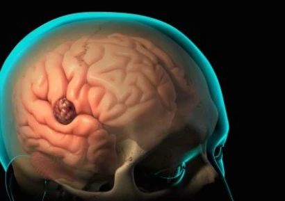 ТУМОР В МОЗЪКА СИМПТОМИ | КОЛКО СЕ ЖИВЕЕ | КАК СЕ ЛЕКУВА