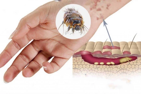 КРАСТА |КОГА ИЗЧЕЗВАТ ПЪПКИТЕ ОТ КРАСТА |ЛЕКАРСТВА И БИЛКИ