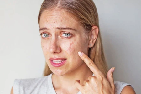 НАЙ-ДОБРОТО ЛЕКАРСТВО ЗА АКНЕ | КРЕМОВЕ, БИЛКИ, ХОМЕОПАТИЯ