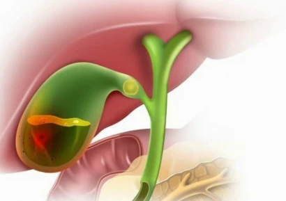 ОСТЪР ХОЛЕЦИСТИТ | КАЛКУЛОЗЕН ХОЛЕЦИСТИТ | СИМПТОМИ, ЛЕЧЕНИЕ