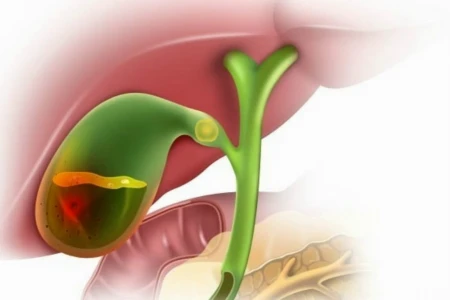 ОСТЪР ХОЛЕЦИСТИТ | КАЛКУЛОЗЕН ХОЛЕЦИСТИТ | СИМПТОМИ, ЛЕЧЕНИЕ