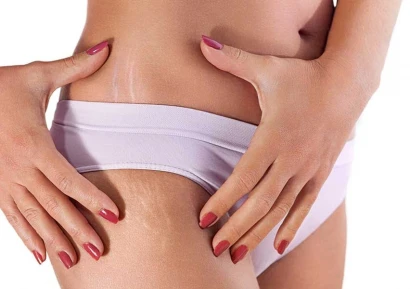 ПРЕМАХВАНЕ НА СТРИИ | КРЕМОВЕ, ОПЕРАЦИИ И БИЛКОВИ РЕЦЕПТИ