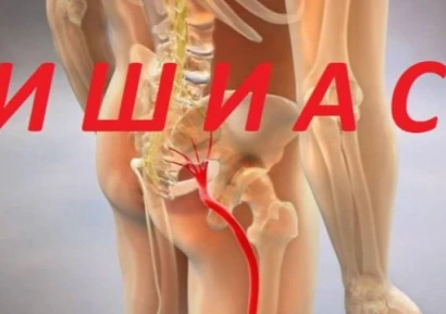 НАЙ-ДОБРИТЕ ЛЕКАРСТВА ПРИ ИШИАС | СИМПТОМИ И ЛЕЧЕНИЕ