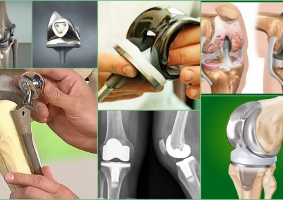 КОЛКО СТРУВА СМЯНАТА НА КОЛЯННА СТАВА