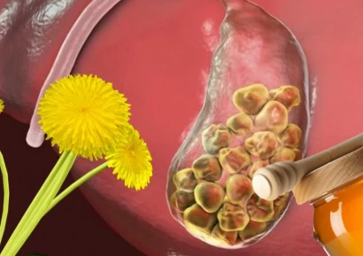 СТОПЯВАНЕ НА КАМЪНИ В ЖЛЪЧКАТА | БИЛКОВИ РЕЦЕПТИ | ДИЕТА