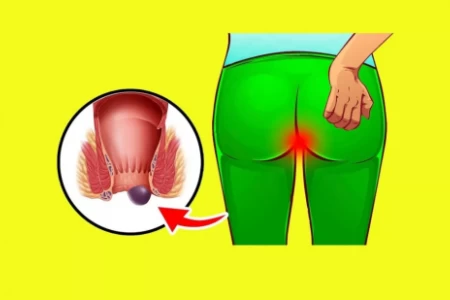 ХЕМОРОИДИ - КАК ДА СЕ ИЗБАВИТЕ ЗАВИНАГИ?