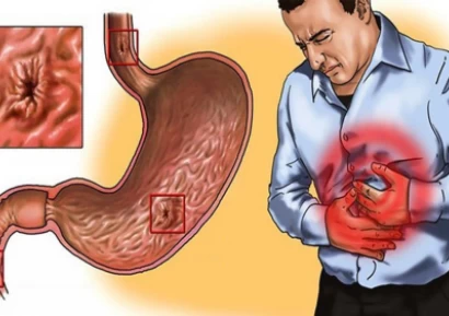 ЯЗВА НА СТОМАХА СИМПТОМИ | ЛЕЧЕНИЕ НА ЯЗВА НА СТОМАХА